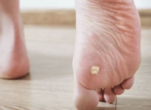 Traitement des verrues